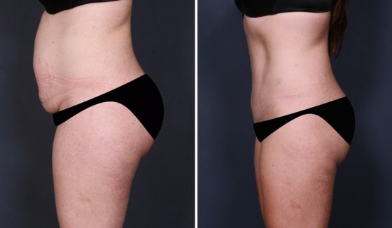 How can you take good before and after photos of your tummy tuck?