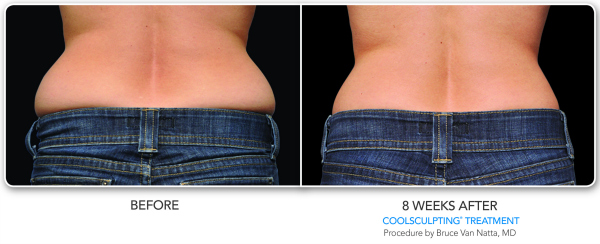 B&A-VanNatta-2Set 600
