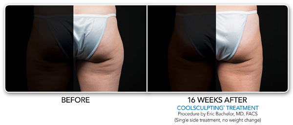 Coosculpting-outer-thighs-example