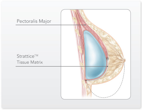 breast lift using botox baseball caps hot gay