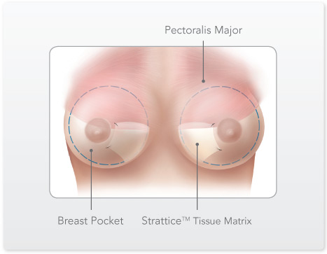 where is my clitoris breast implant out of pocket symptoms