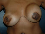 Breast Revision with Strattice: Patient #3 before
