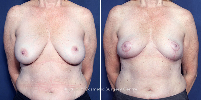 breast implant lift porn no credit card full access