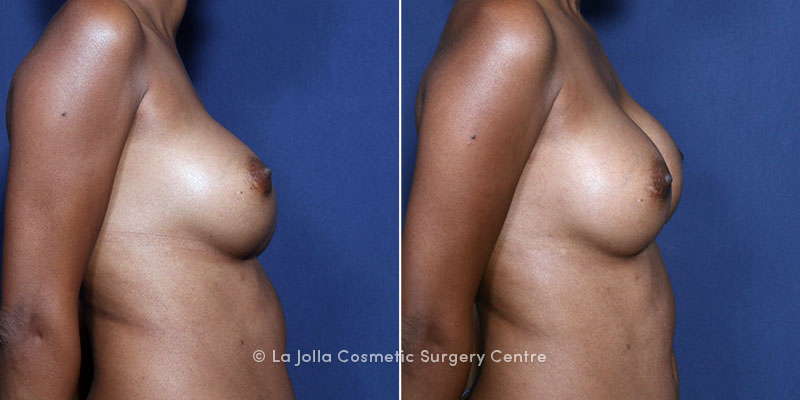 sitting on girl anal breast augmentation replacement