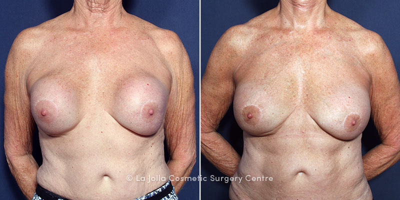 sex positioons breast augmentation replacement