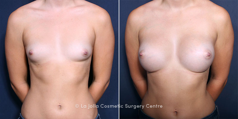 Augmentation breast jolla la surgery