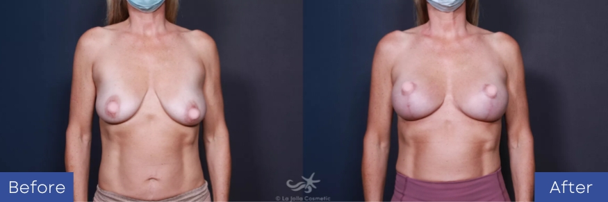 before & after breast lift procedure - case 559