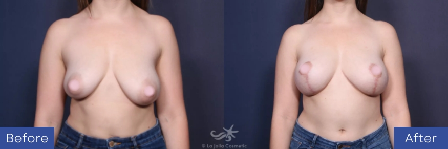 before & after breast lift procedure - case 31