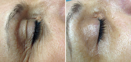 oxygeneo-before-and-after-eyelids