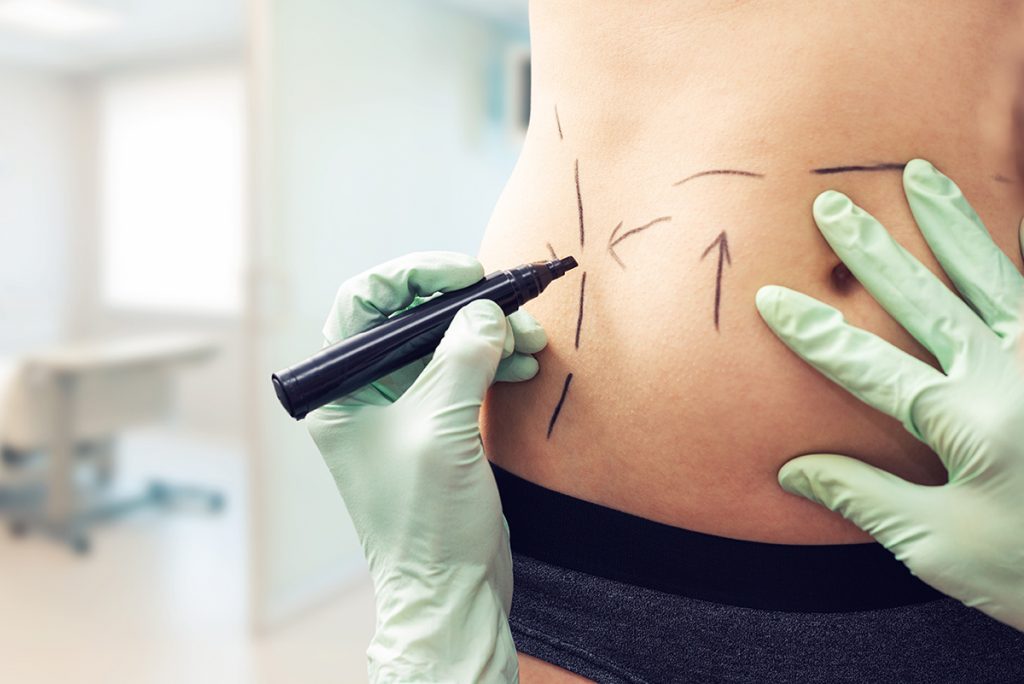 doctor marking patient's abdomen for liposuction surgery