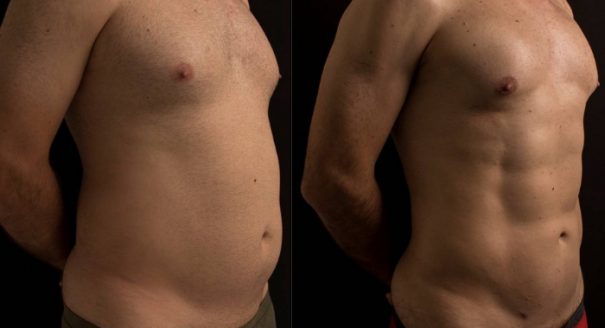 Before and after HD Lipo on a male chest, abs & arms