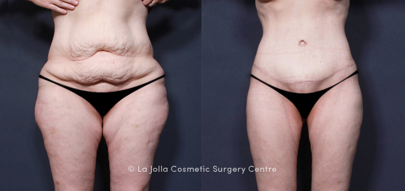 Before and after post-weight loss surgery on the abdomen and thighs