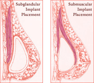 breast implant position