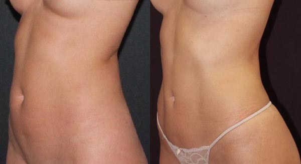 Before and after HD lipo on a female abdomen