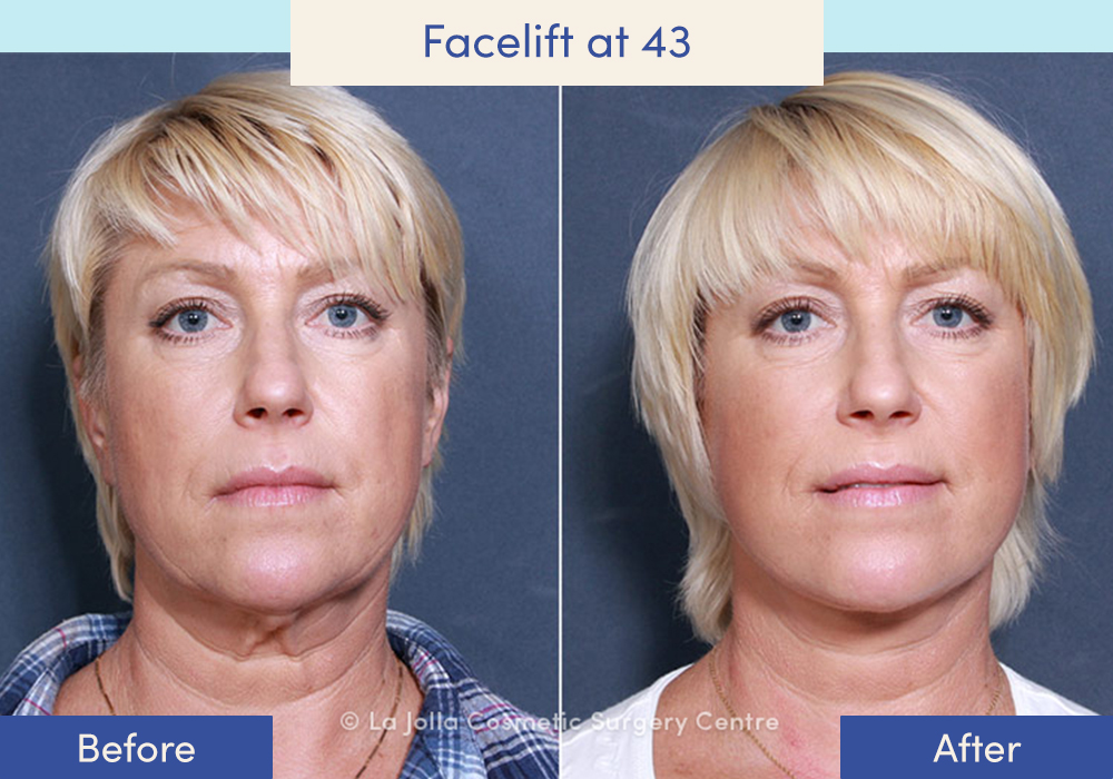 Before and after of a female who had a facelift at 43