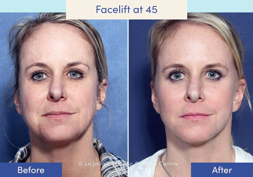 Before and after of a female who had a facelift at 45