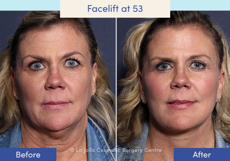 Facelift Before & After Photos What a Facelift Looks Like at 40, 50