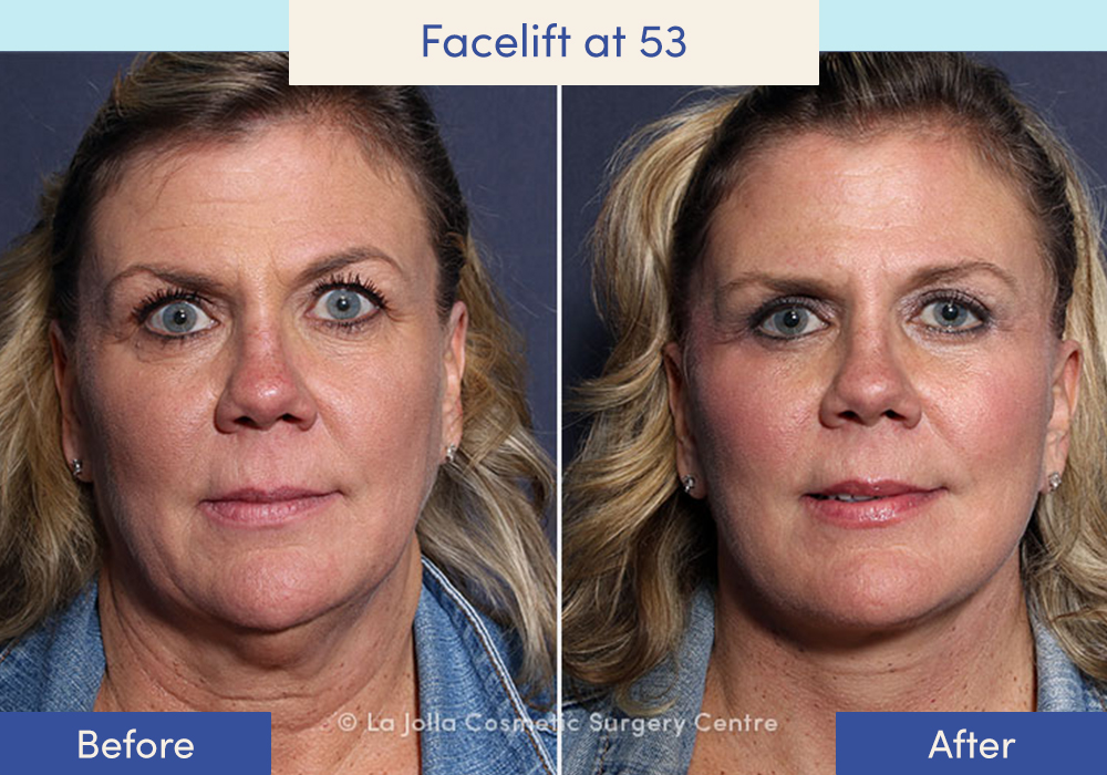 Before and after of a female who had a facelift at 53