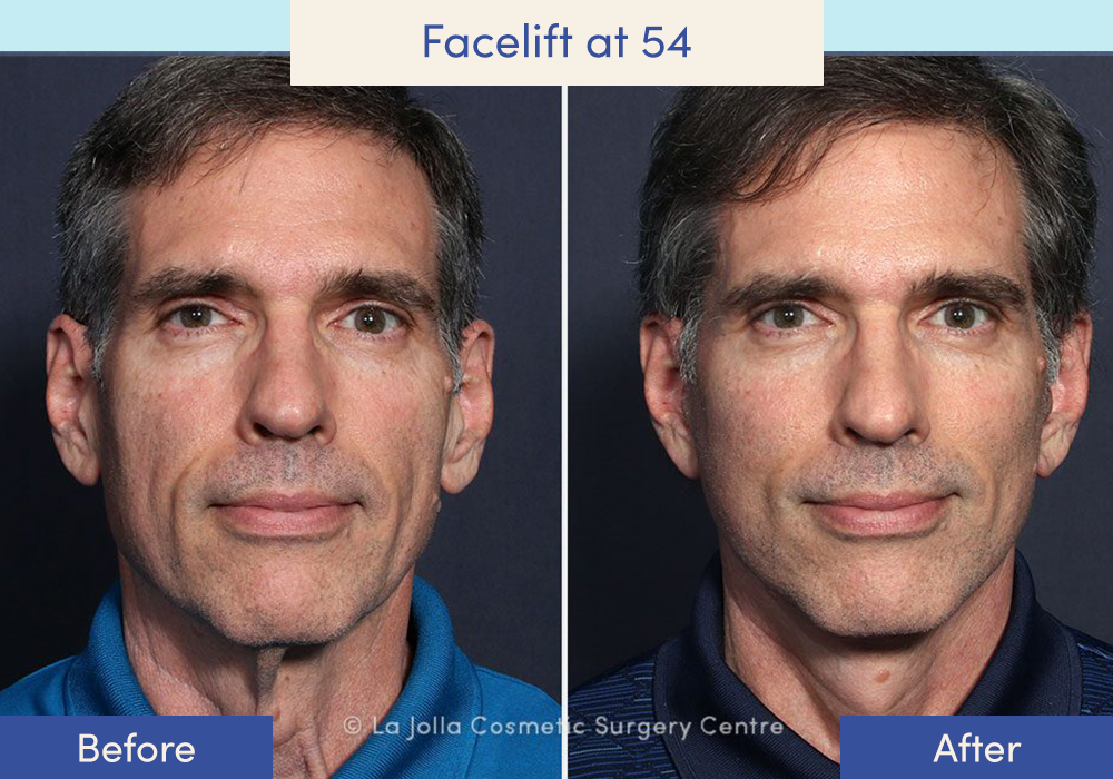 Before and after of a male who had a facelift at 54