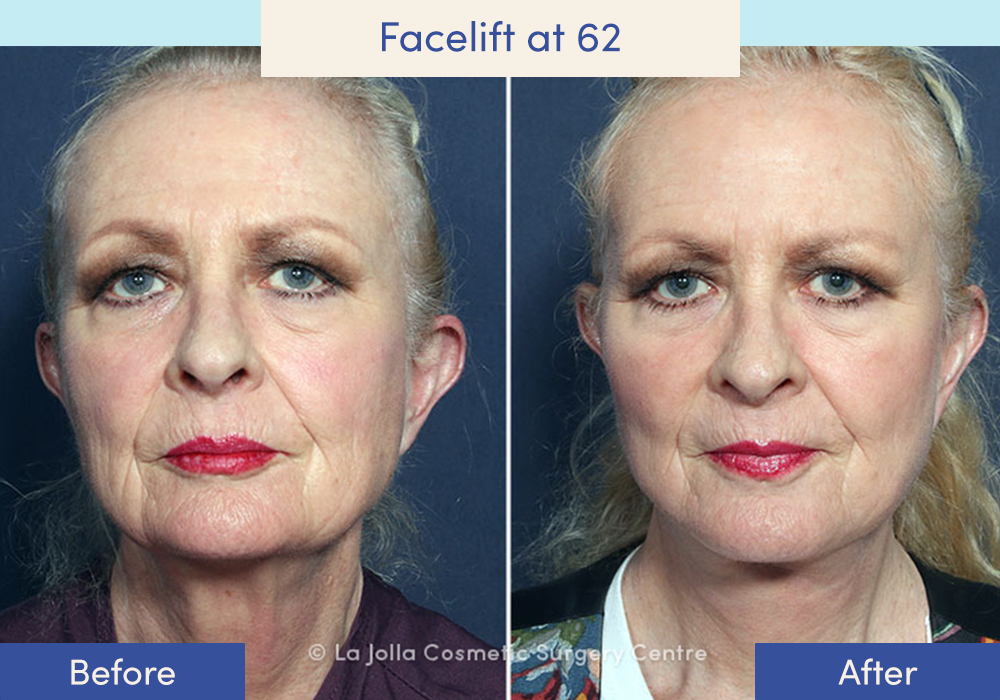 Before and after of a female who had a facelift at 62