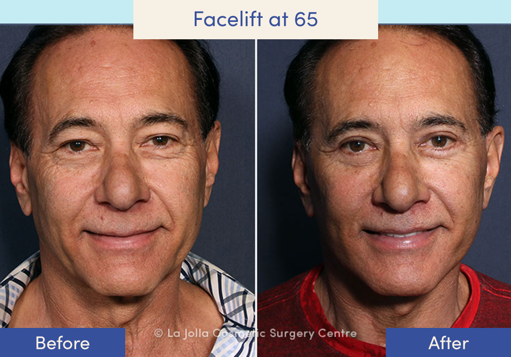 Before and after of a male who had a facelift at 65