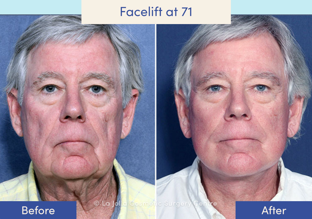 Before and after of a male who had a facelift at 71