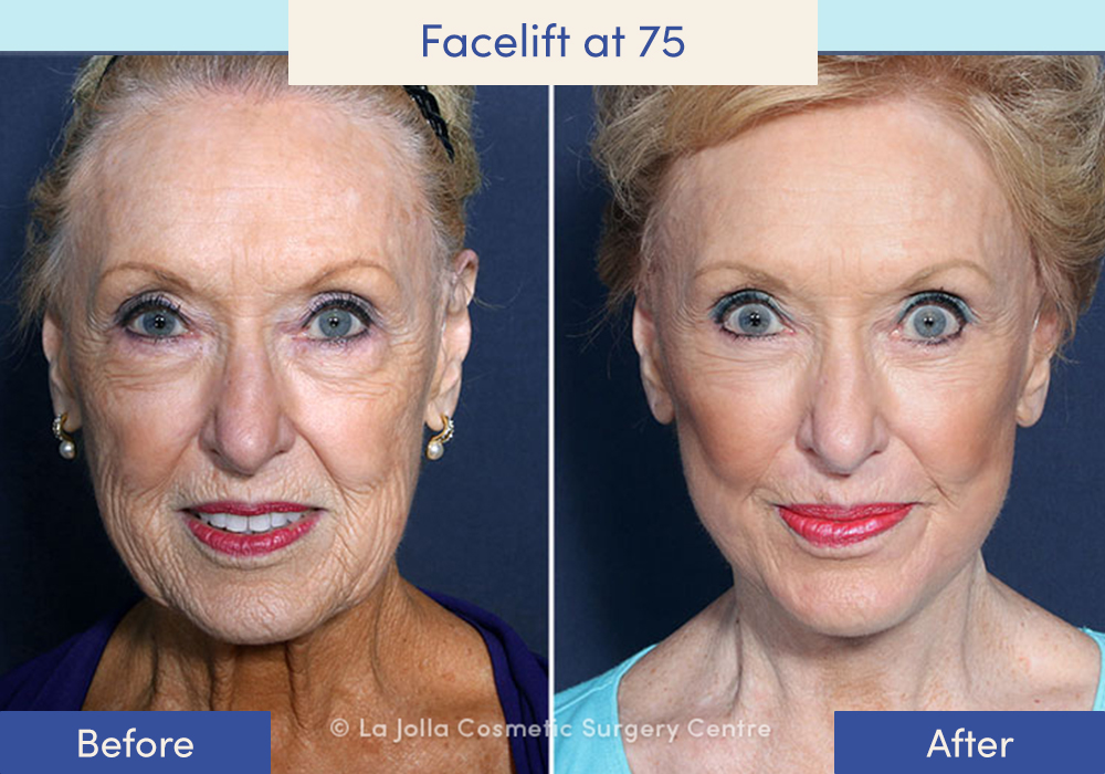 Before and after of a female who had a facelift at 75