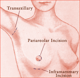Breast Incicsion Choices