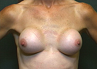 pictures of capsular contracture