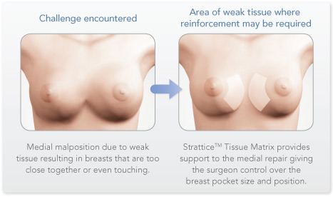 Treatment for Symmastia, Strattice Tissue Matrix