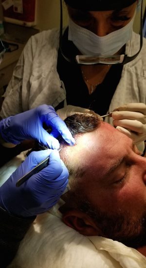 Dr. Salazar performs a SmartGraft hair transplant on a male patient