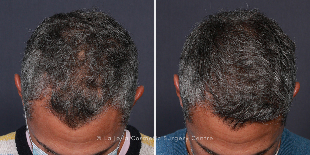 Hair restoration patient, La Jolla, CA