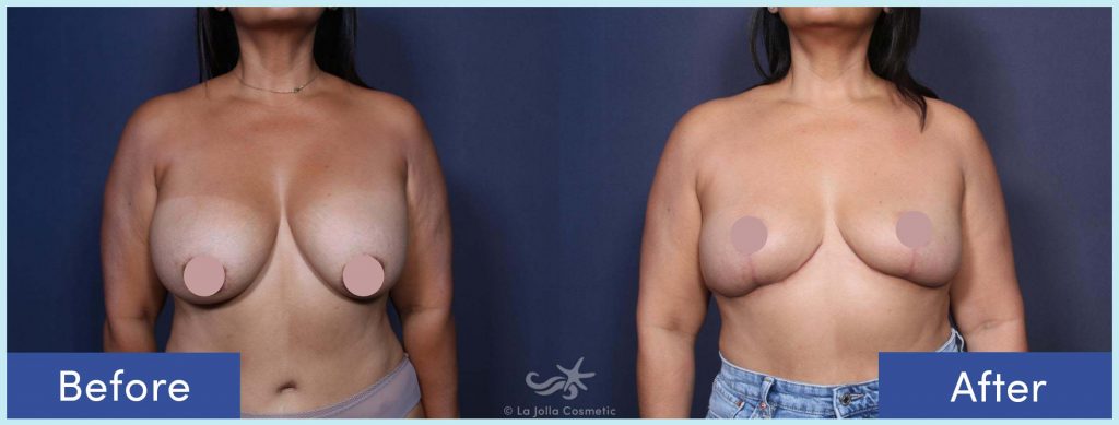 Before-and-After: Breast Implant Removal