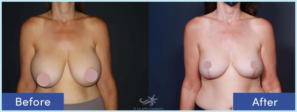 Before-and-After: Breast Implant Removal