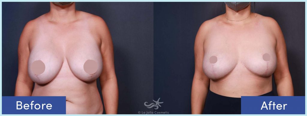 Before-and-After: Breast Implant Removal