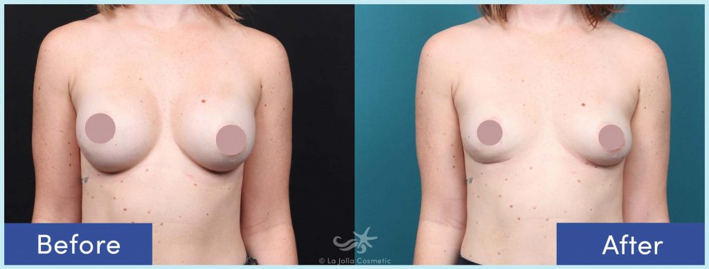 Before-and-After: Breast Implant Removal