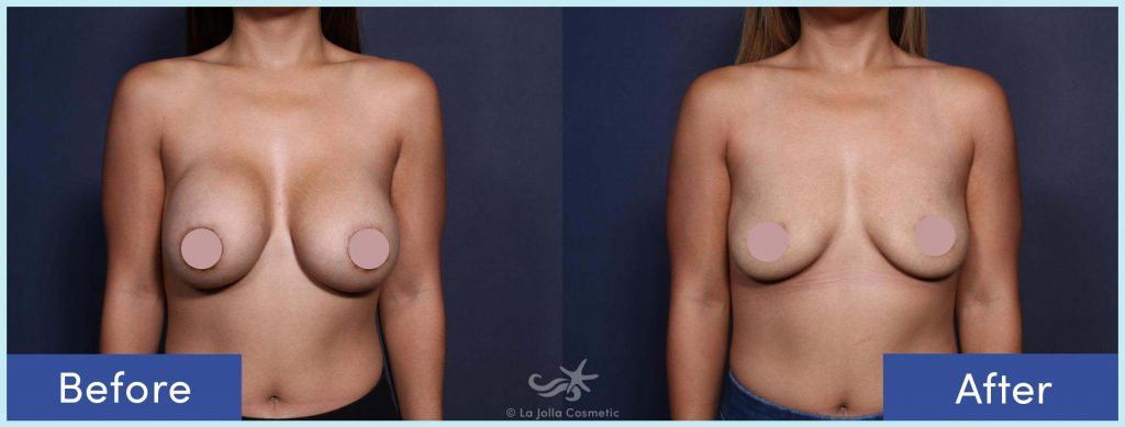 Before-and-After: Breast Implant Removal