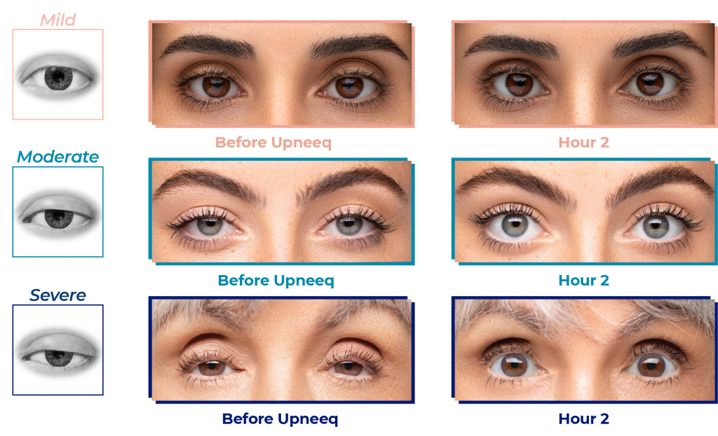 Upneeq chart illustrating various levels of Acquired ptosis and real patient results at each level.