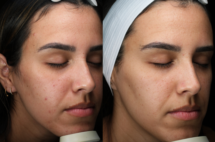 Close-ups of Danielle before and after microneedling treatments