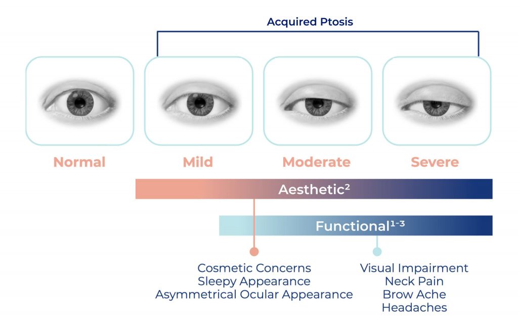 Upneeq chart showing various stages of Acquired Ptosis