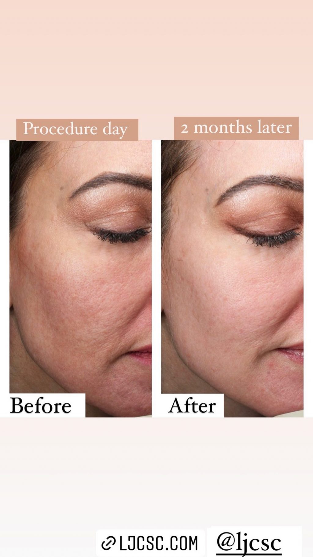 Side-by-side close-ups of the side of Lisa's face before (left) and two months after (right) laser treatments