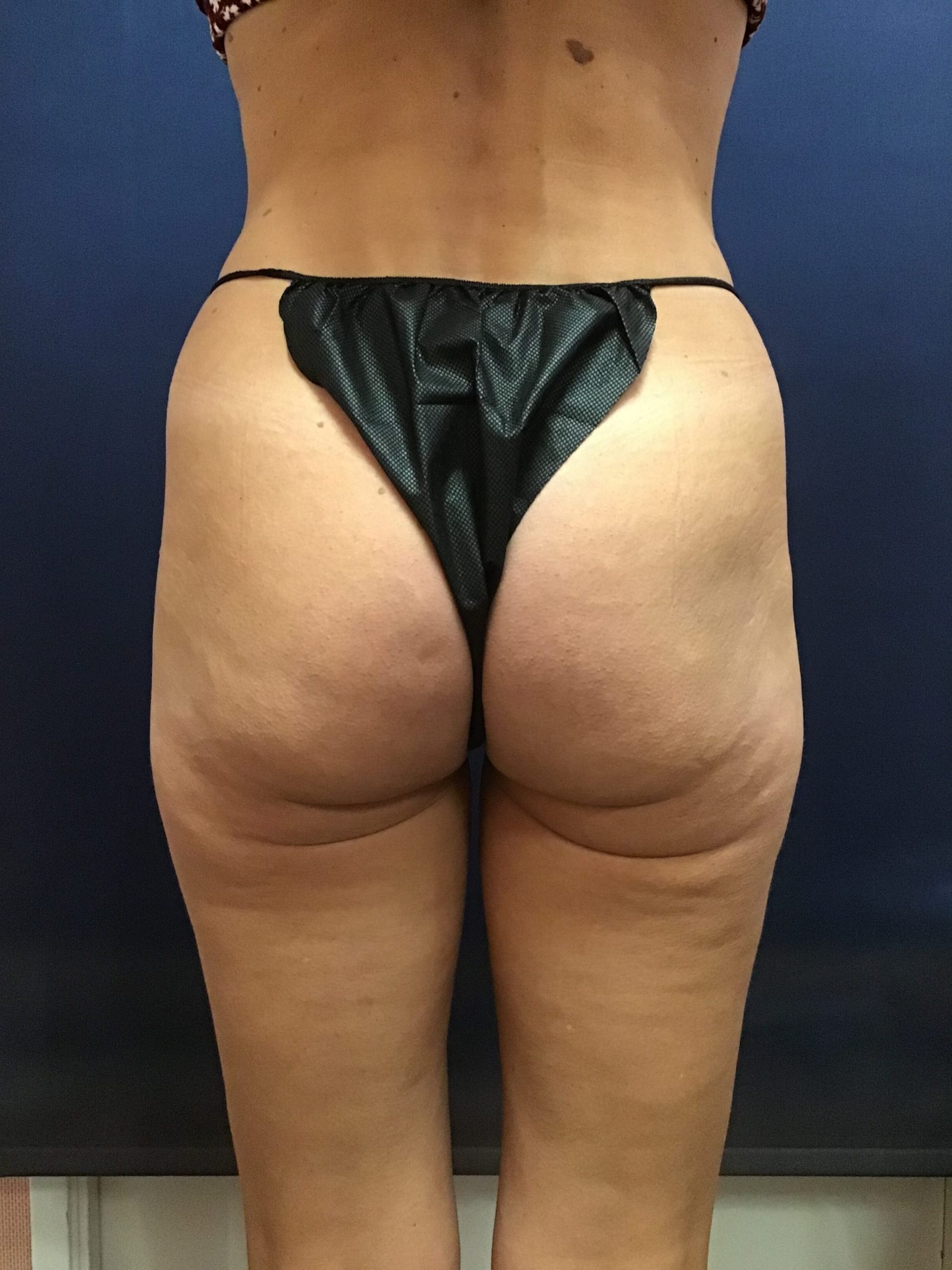 April's butt/back of thighs in January 2022, two months after receiving final QWO treatment at LJC