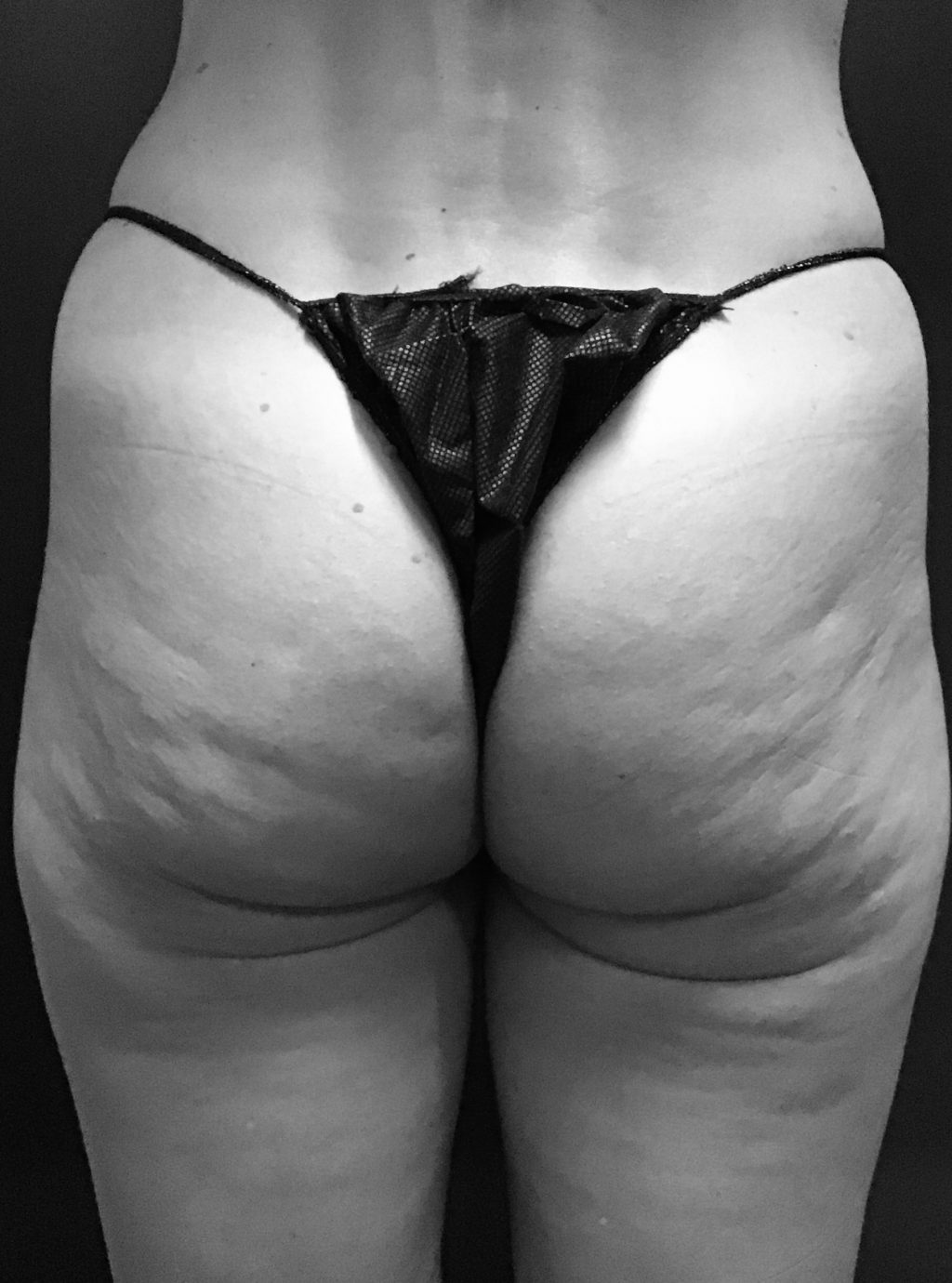 April's butt/back of thighs in October 2021, after first QWO treatment and before second