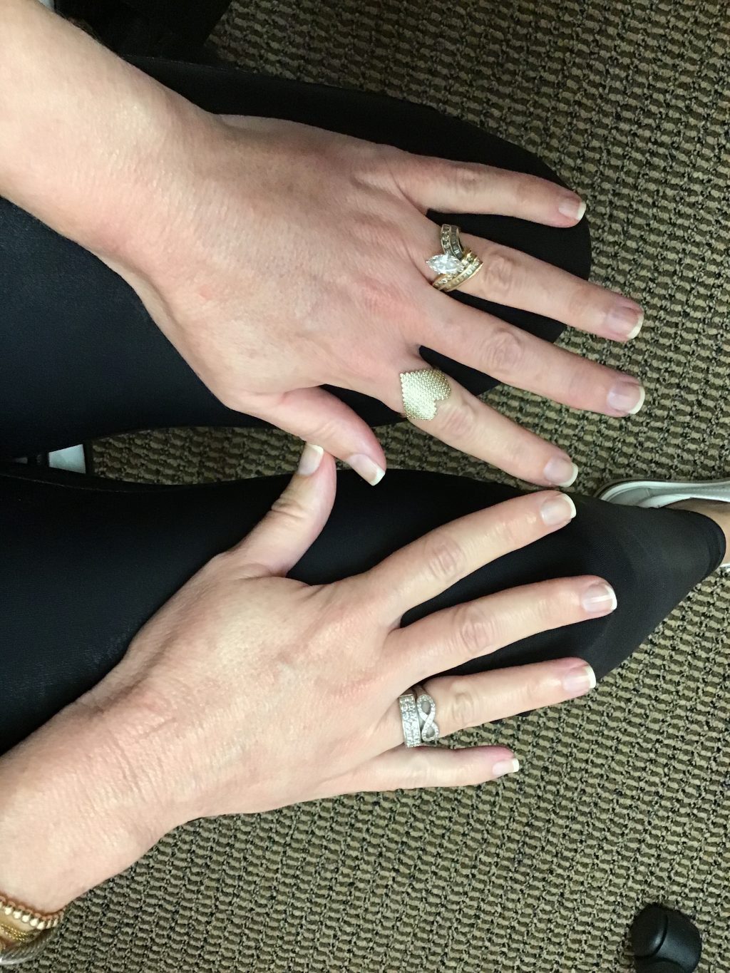 Lisa's hands after receiving laser treatments and Radiesse filler at LJC. Visibly less sun damage, less veiny, and more youthful-looking.