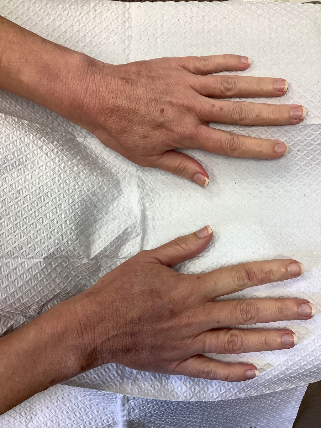Lisa's hands before receiving laser treatments and Radiesse filler at LJC. Visibly aged in appearance from sun damage, exposed veins.
