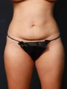 Front view of Fatima's stomach in October 2021 after receiving two CoolSculpting treatments; noticeably larger than it looked before treatments