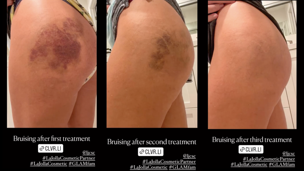 Three side-by-side photos of the bruises on April's side butt after first, second, and third QWO treatments pulled from her Instagram Story