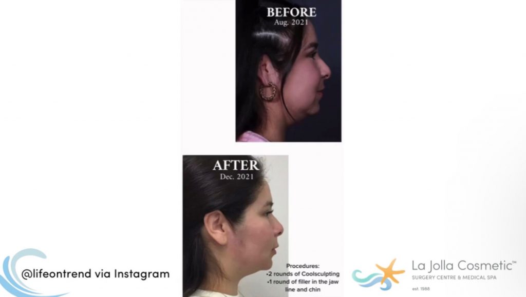 Comparison photos of Pamela's jawline and chin from the side in Aug. 2021 before receiving treatments at LJC (top) vs. Dec. 2021, after receiving treatments (bottom)