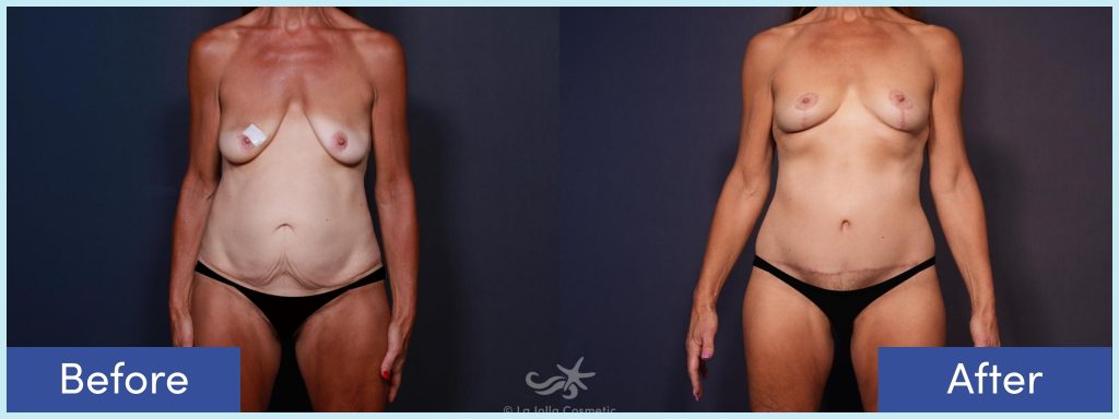 Breast lift, tummy tuck and body lift before and after photo