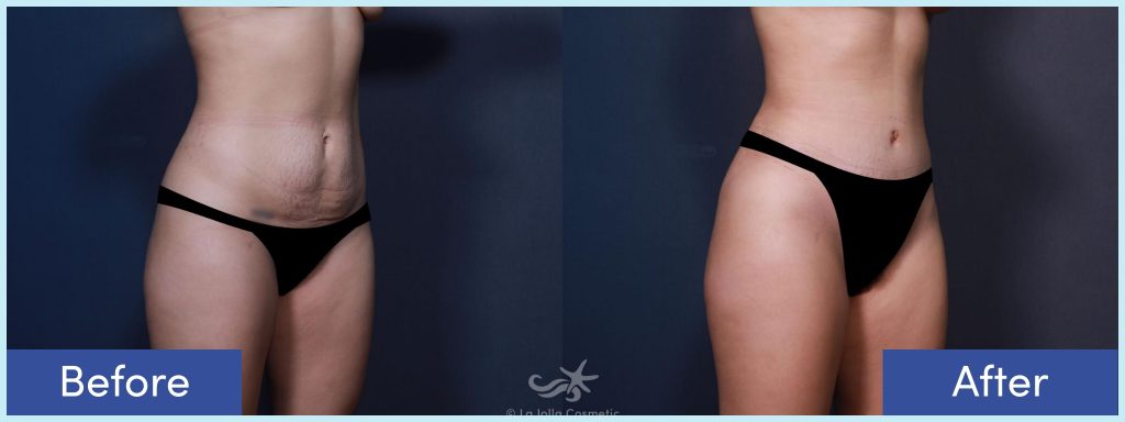 Liposuction and tummy tuck before and after photo